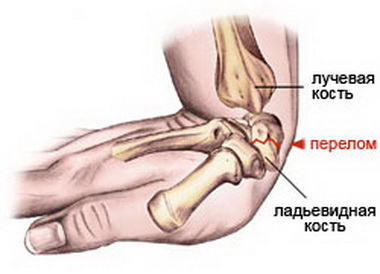 Житель Грачевского района сломал сожительнице руку
